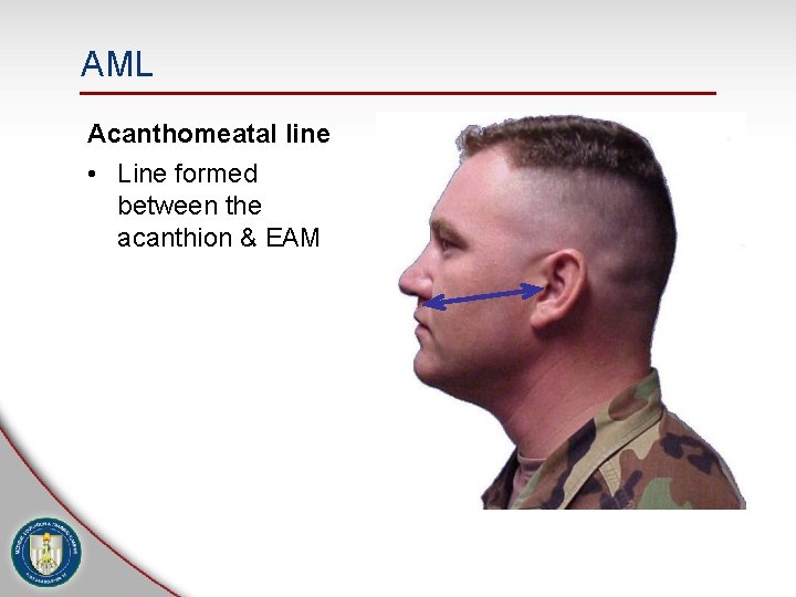 AML Acanthomeatal line • Line formed between the acanthion & EAM 