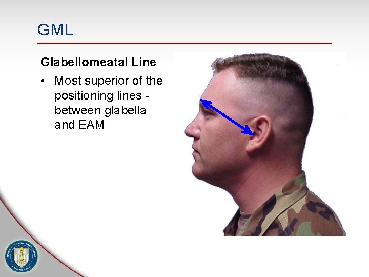 GML Glabellomeatal Line • Most superior of the positioning lines between glabella and EAM