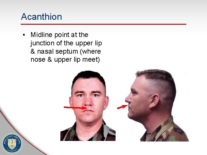 Acanthion • Midline point at the junction of the upper lip & nasal septum