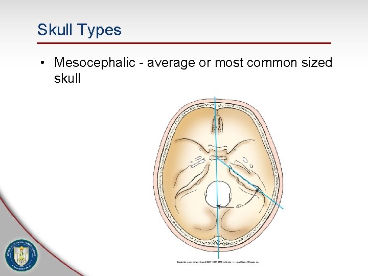 Skull Types • Mesocephalic - average or most common sized skull 