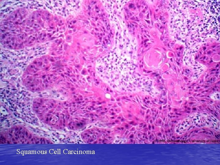  Squamous Cell Carcinoma 