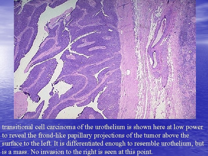 transitional cell carcinoma of the urothelium is shown here at low power to reveal