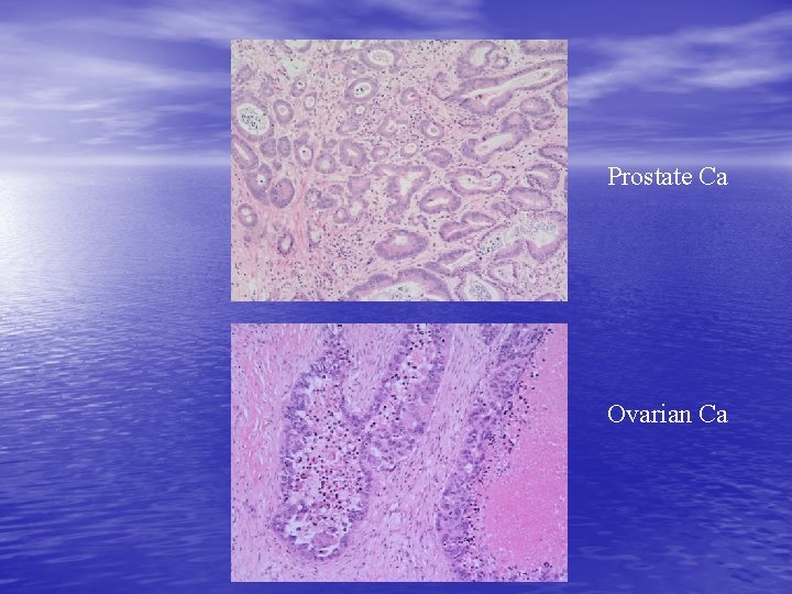 Prostate Ca Ovarian Ca 