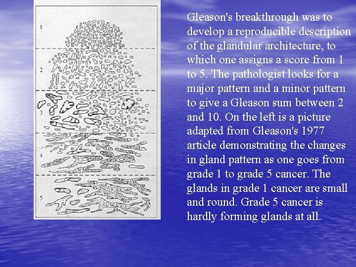 Gleason's breakthrough was to develop a reproducible description of the glandular architecture, to which