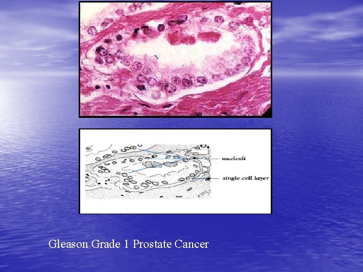  Gleason Grade 1 Prostate Cancer 