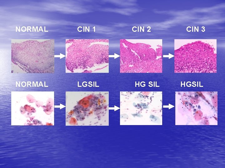 NORMAL CIN 1 NORMAL LGSIL CIN 2 HG SIL CIN 3 HGSIL 