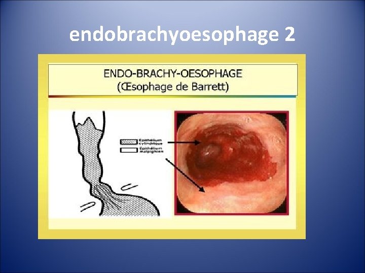 endobrachyoesophage 2 