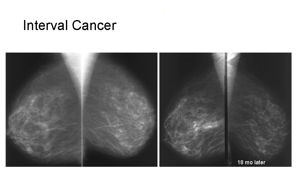 : Interval Cancer 18 mo later 
