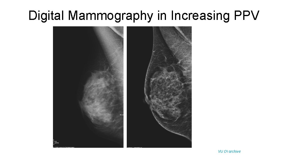 Digital Mammography in Increasing PPV VU OI archive 