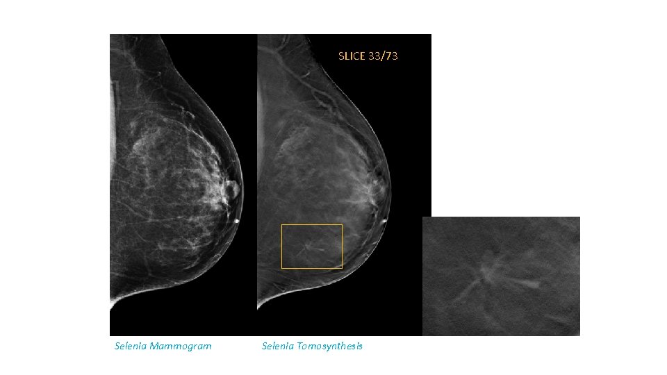 SLICE 33/73 Selenia Mammogram Selenia Tomosynthesis 
