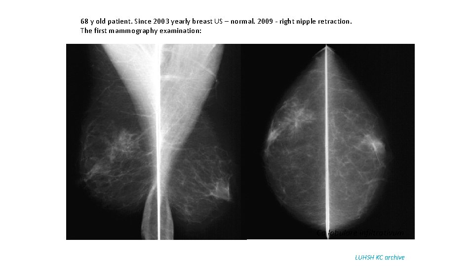 68 y old patient. Since 2003 yearly breast US – normal. 2009 - right