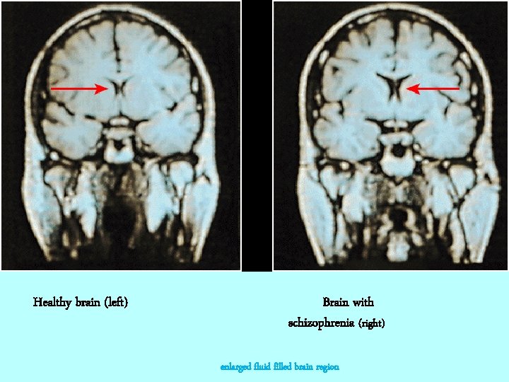 Healthy brain (left) Brain with schizophrenia (right) enlarged fluid filled brain region 