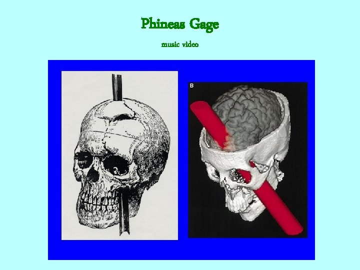 Phineas Gage music video 