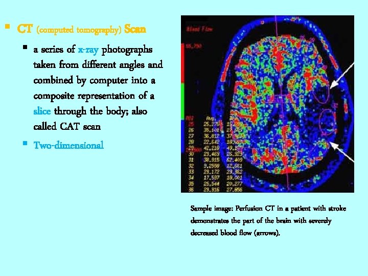 § CT (computed tomography) Scan § a series of x-ray photographs taken from different