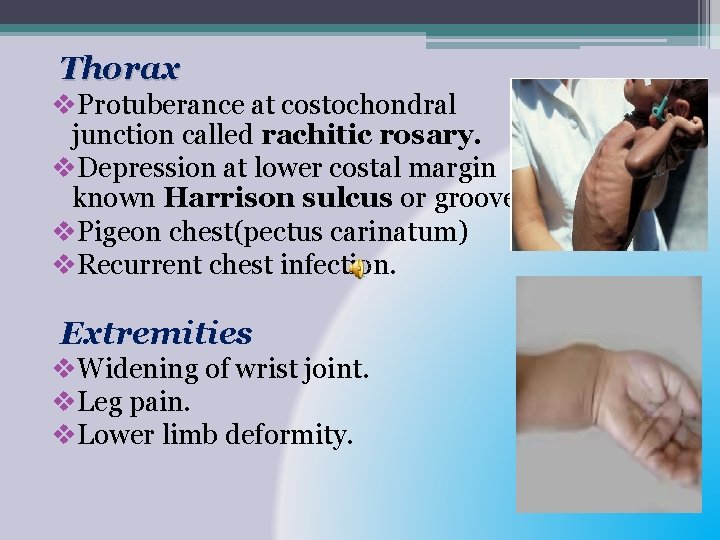 Thorax v. Protuberance at costochondral junction called rachitic rosary. v. Depression at lower costal