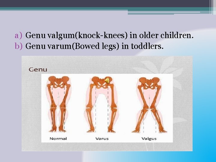 a) Genu valgum(knock-knees) in older children. b) Genu varum(Bowed legs) in toddlers. 