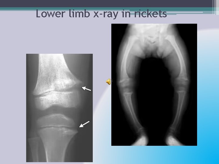 Lower limb x-ray in rickets 