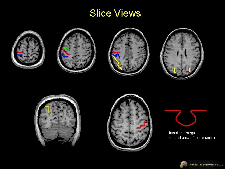 Slice Views inverted omega = hand area of motor cortex 