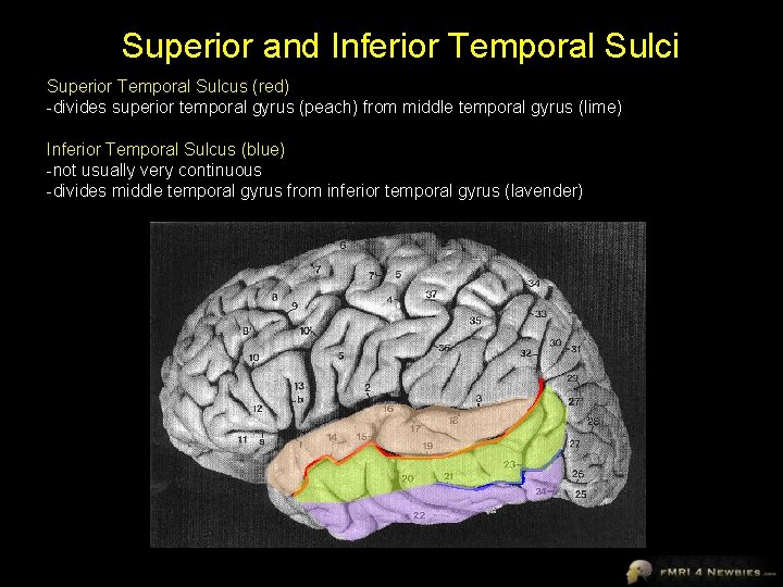 Superior and Inferior Temporal Sulci Superior Temporal Sulcus (red) -divides superior temporal gyrus (peach)