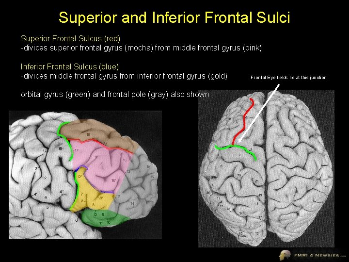 Superior and Inferior Frontal Sulci Superior Frontal Sulcus (red) -divides superior frontal gyrus (mocha)