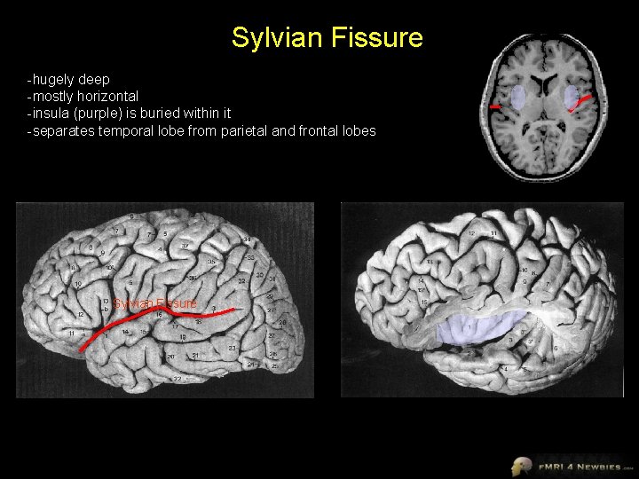 Sylvian Fissure -hugely deep -mostly horizontal -insula (purple) is buried within it -separates temporal