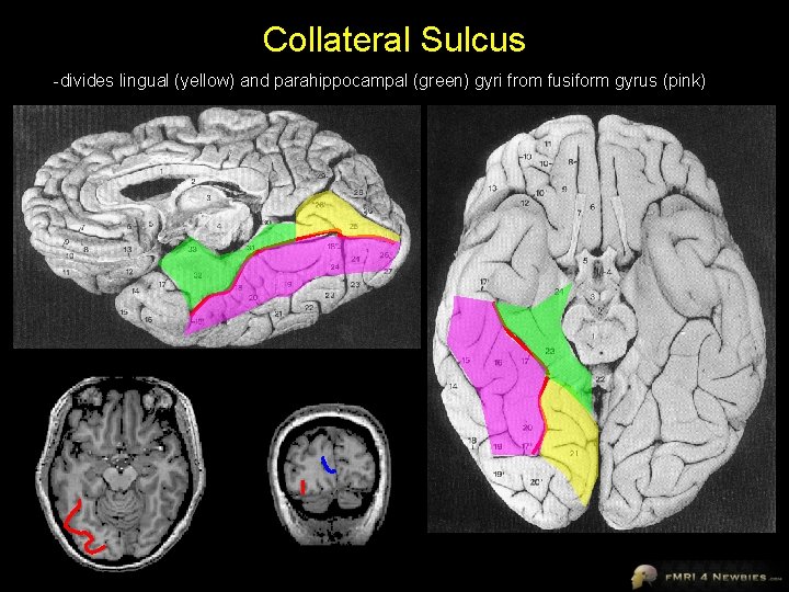 Collateral Sulcus -divides lingual (yellow) and parahippocampal (green) gyri from fusiform gyrus (pink) 