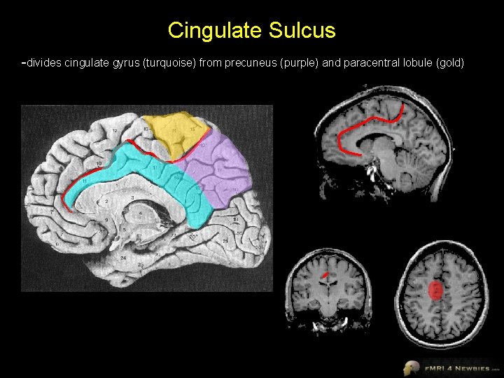 Cingulate Sulcus -divides cingulate gyrus (turquoise) from precuneus (purple) and paracentral lobule (gold) 