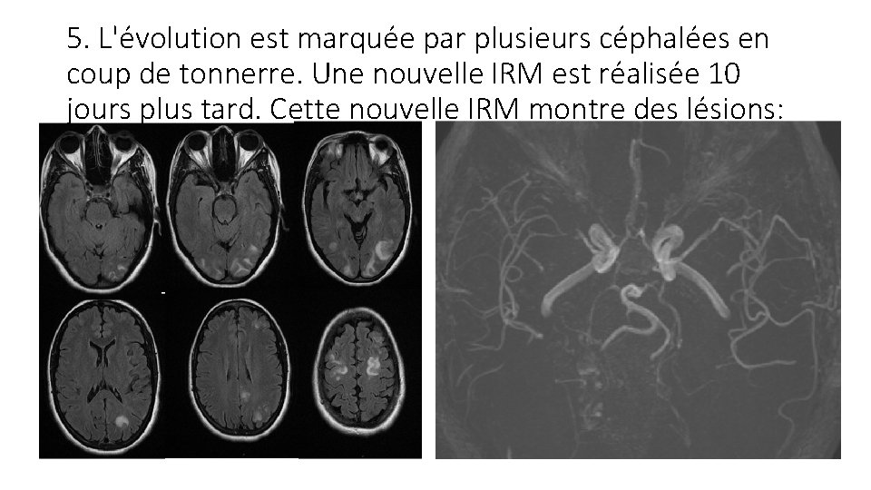 5. L'évolution est marquée par plusieurs céphalées en coup de tonnerre. Une nouvelle IRM