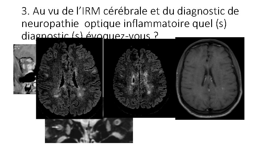 3. Au vu de l’IRM cérébrale et du diagnostic de neuropathie optique inflammatoire quel