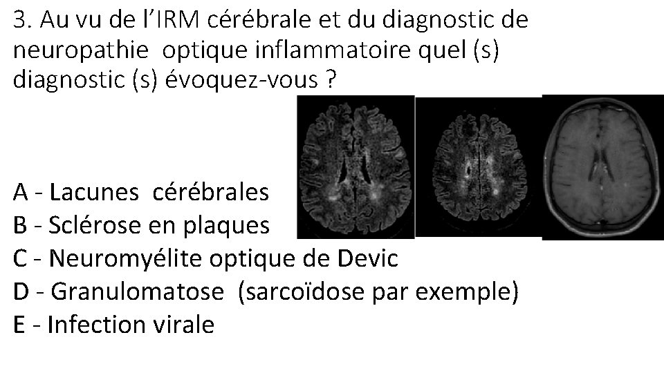3. Au vu de l’IRM cérébrale et du diagnostic de neuropathie optique inflammatoire quel
