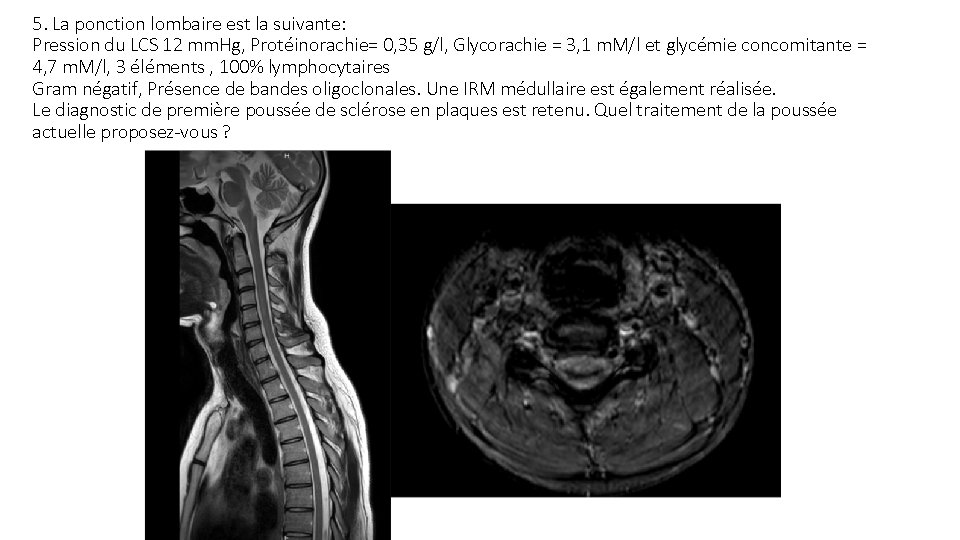 5. La ponction lombaire est la suivante: Pression du LCS 12 mm. Hg, Protéinorachie=