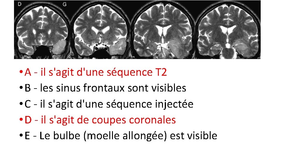  • A - il s'agit d'une séquence T 2 • B - les