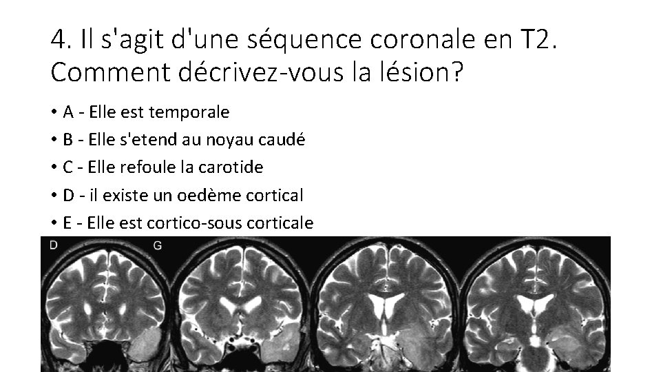 4. Il s'agit d'une séquence coronale en T 2. Comment décrivez-vous la lésion? •