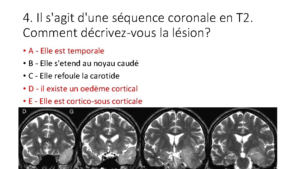 4. Il s'agit d'une séquence coronale en T 2. Comment décrivez-vous la lésion? •