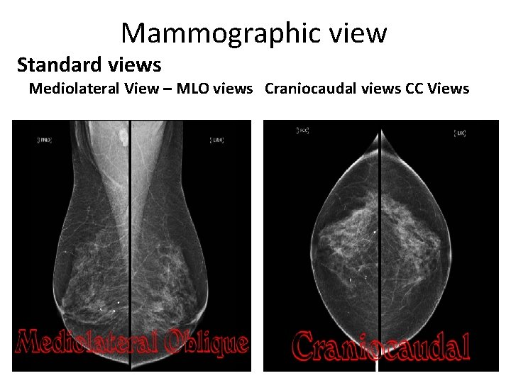 Mammographic view Standard views Mediolateral View – MLO views Craniocaudal views CC Views 
