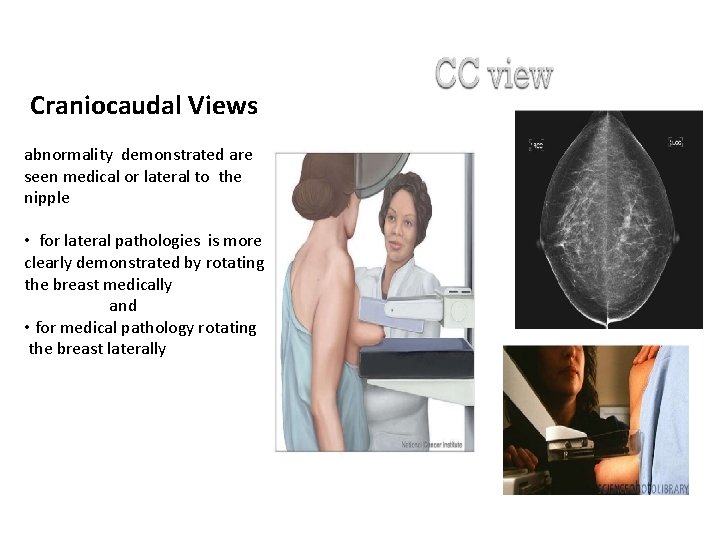  Craniocaudal Views abnormality demonstrated are seen medical or lateral to the nipple •