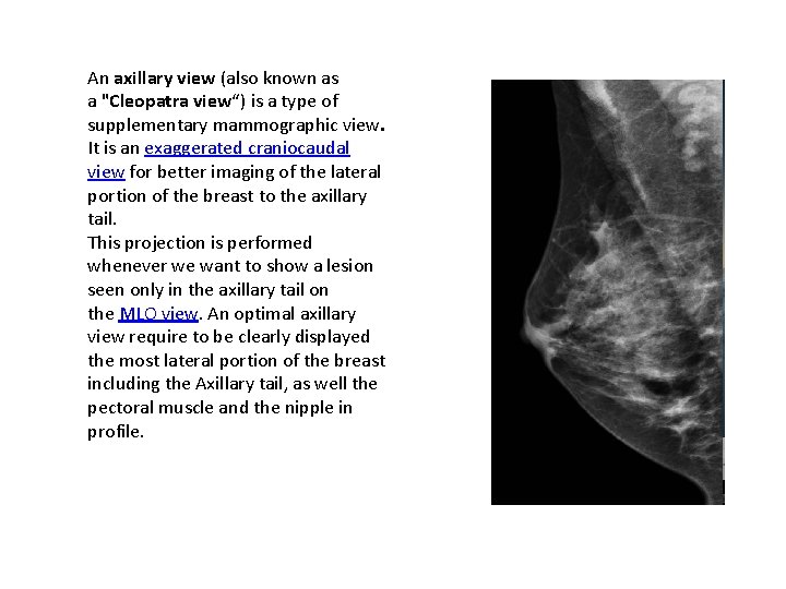 An axillary view (also known as a "Cleopatra view“) is a type of supplementary