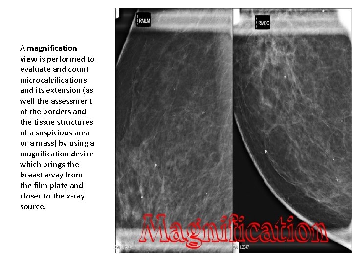 A magnification view is performed to evaluate and count microcalcifications and its extension (as