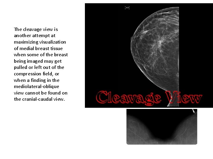  The cleavage view is another attempt at maximizing visualization of medial breast tissue