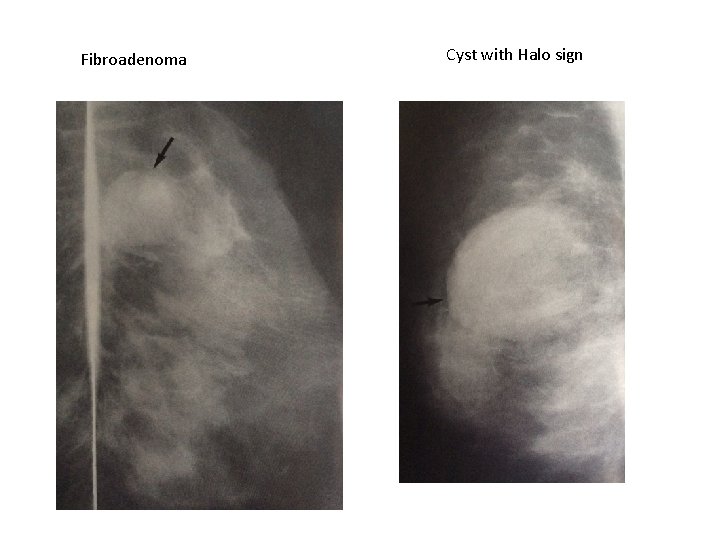 Fibroadenoma Cyst with Halo sign 