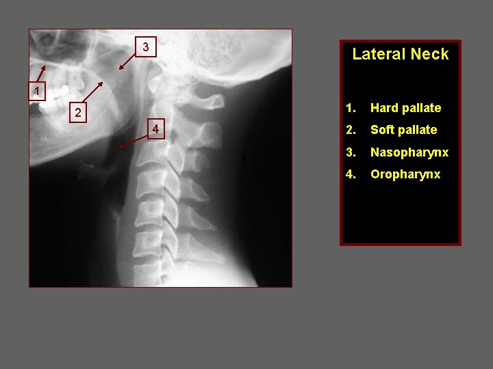 3 Lateral Neck 1 2 4 4 1. Hard pallate 2. Soft pallate 3.