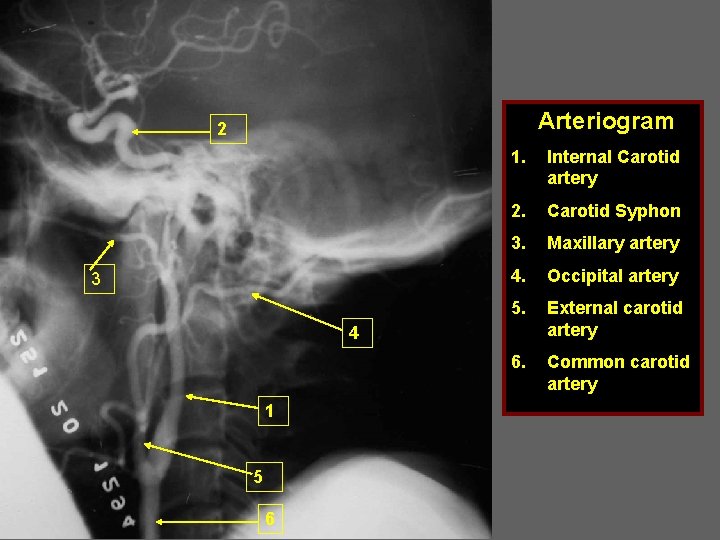Arteriogram 2 3 1. Internal Carotid artery 2. Carotid Syphon 3. Maxillary artery 4.