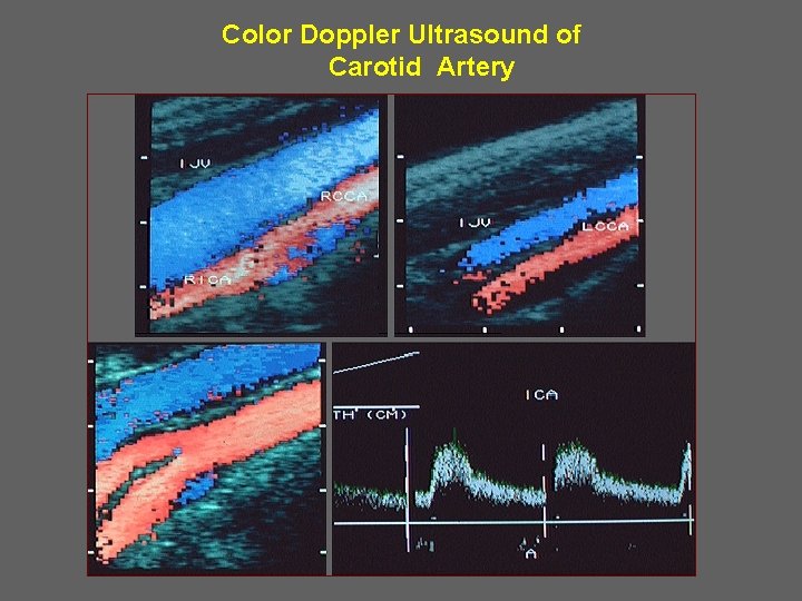 Color Doppler Ultrasound of Carotid Artery 