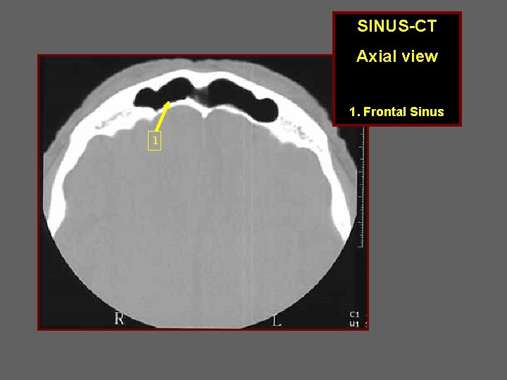 SINUS-CT Axial view 1. Frontal Sinus 1 