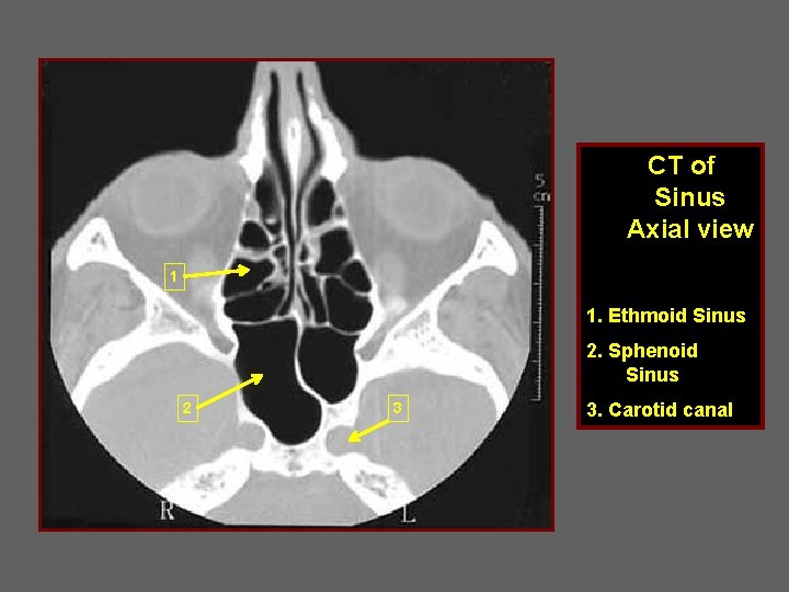 CT of Sinus Axial view 1 1. Ethmoid Sinus 2. Sphenoid Sinus 2 3