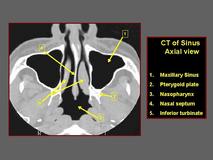 1 CT of Sinus Axial view 4 2 5 3 1. Maxillary Sinus 2.