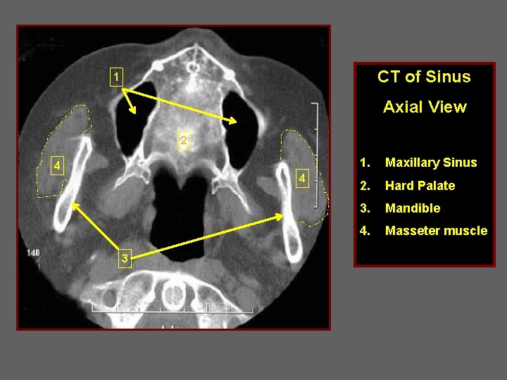 CT of Sinus 1 Axial View 2 4 4 3 3 1. Maxillary Sinus
