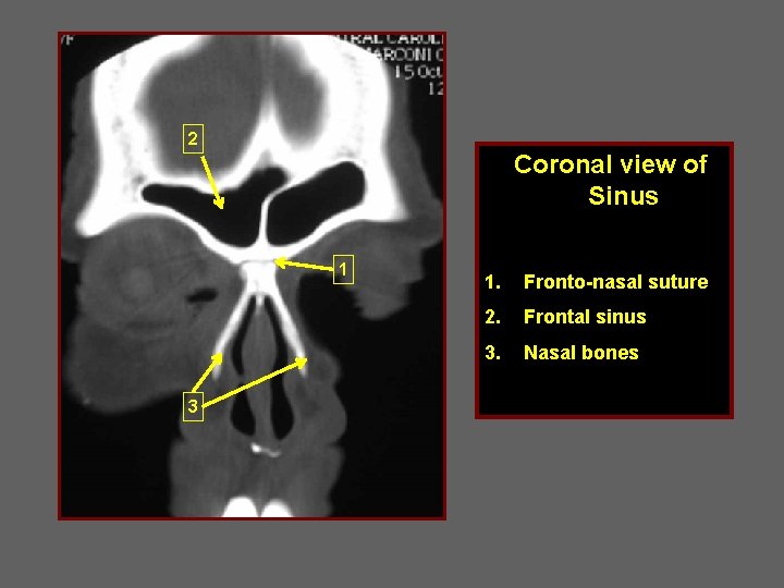 2 Coronal view of Sinus 1 3 1. Fronto-nasal suture 2. Frontal sinus 3.