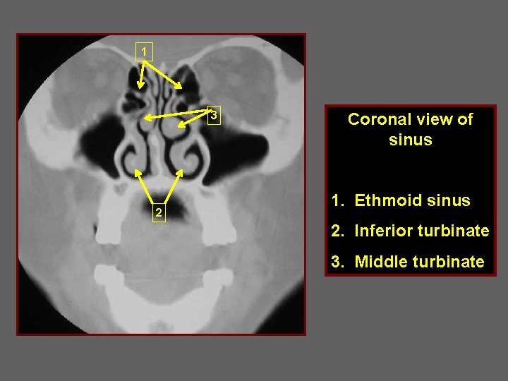 1 3 2 Coronal view of sinus 1. Ethmoid sinus 2. Inferior turbinate 3.