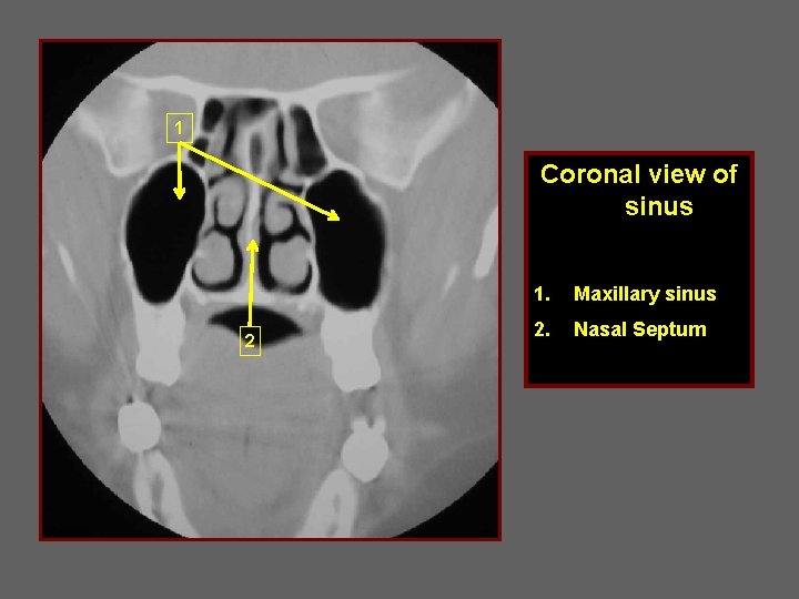 1 Coronal view of sinus 2 1. Maxillary sinus 2. Nasal Septum 